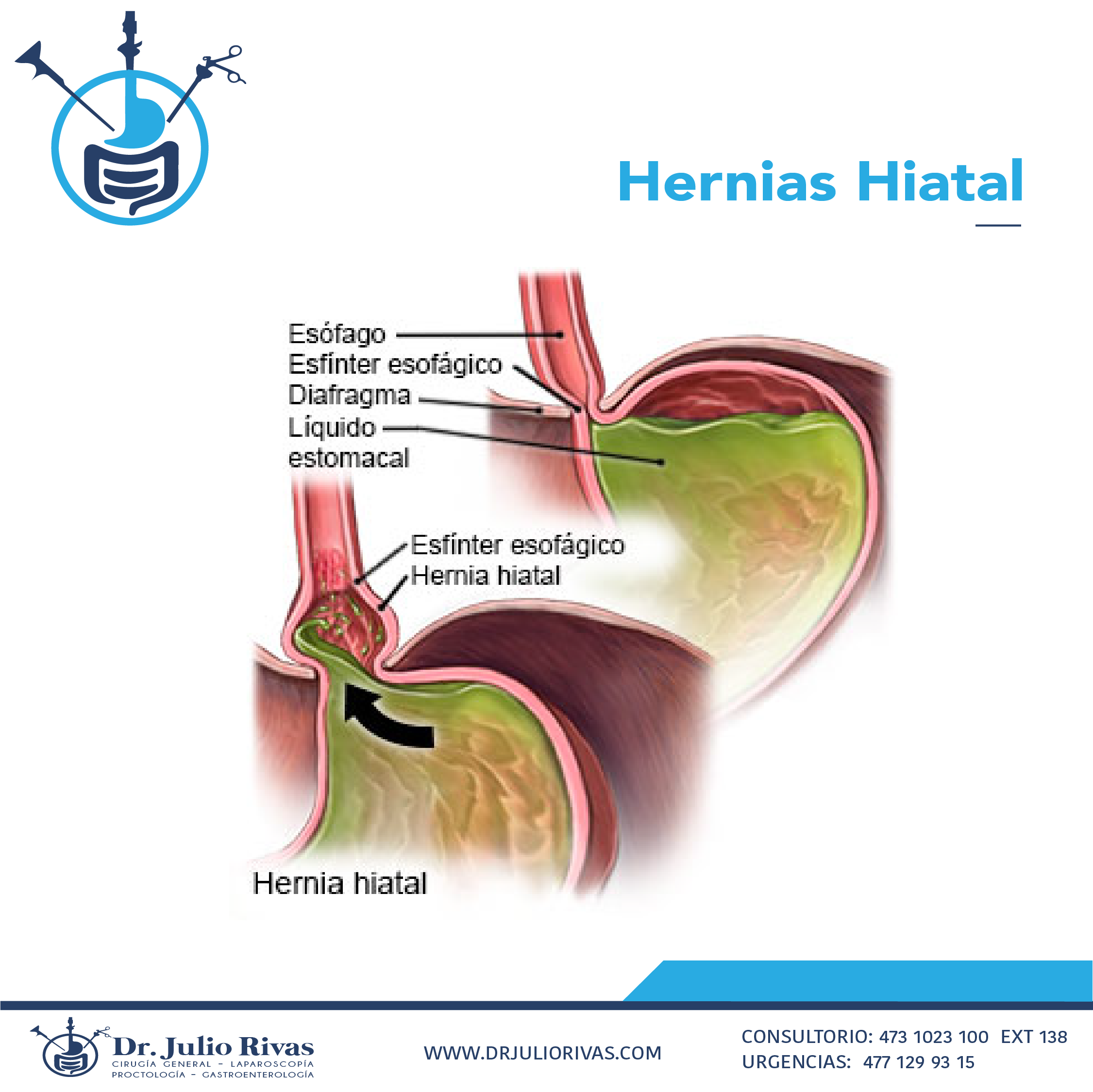 TRATAMIENTO DE HERNIA HIATAL EN GUANAJUATAO, ¿CUÁLES SON LOS SÍNTOMAS Y CÓMO SE ATIENDE?